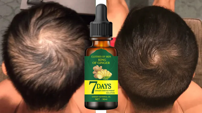 Ginger Germinal Oil, Ginger Hair Growth Serum, Ginger Essential Oil Stop Hair Loss Hair, Thinning Treatment Hair Growth Oil for Women & Men 30ML