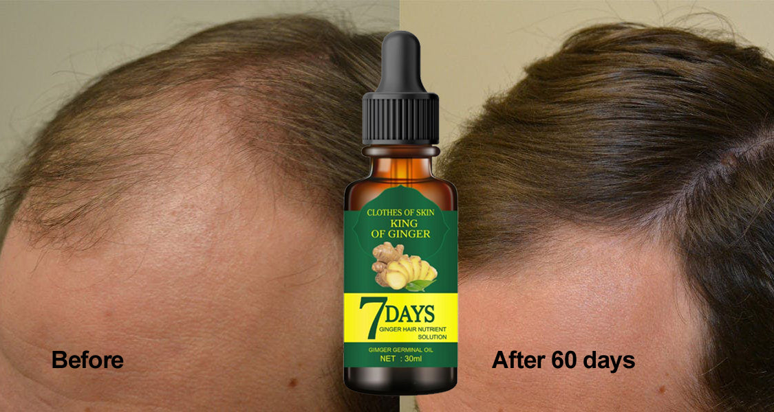 Ginger Germinal Oil, Ginger Hair Growth Serum, Ginger Essential Oil Stop Hair Loss Hair, Thinning Treatment Hair Growth Oil for Women & Men 30ML